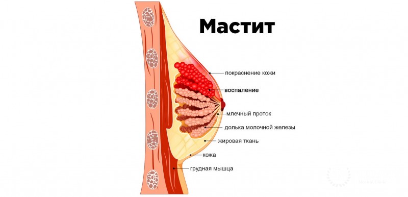 Мастит - информация