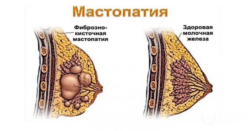 Мастопатия - информация