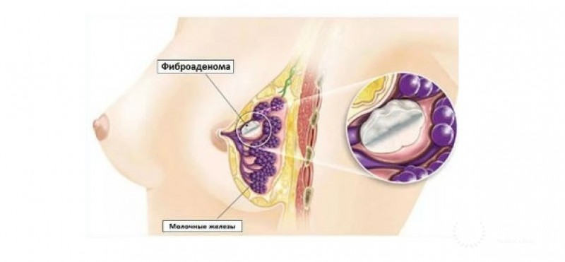 Фиброаденома молочной железы: информация