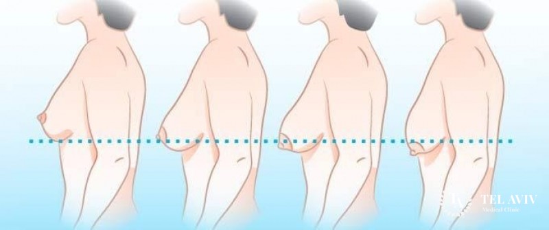 Маммопластика: информация