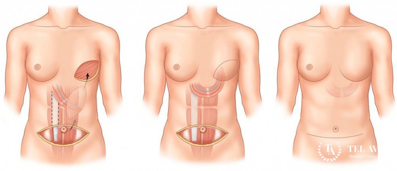 Мастэктомия: информация