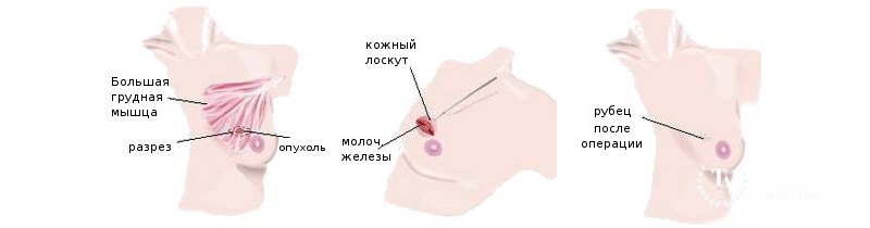 Лампэктомия: информация