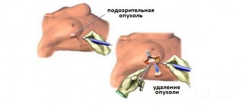 Радикальная секторальная резекция (по Блохину): информация