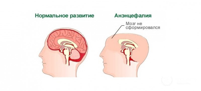 Анэнцефалия плода: вся информация