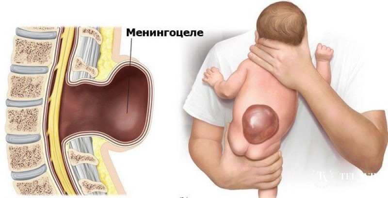 Менингоцеле (спинномозговая грыжа) у детей: вся информация