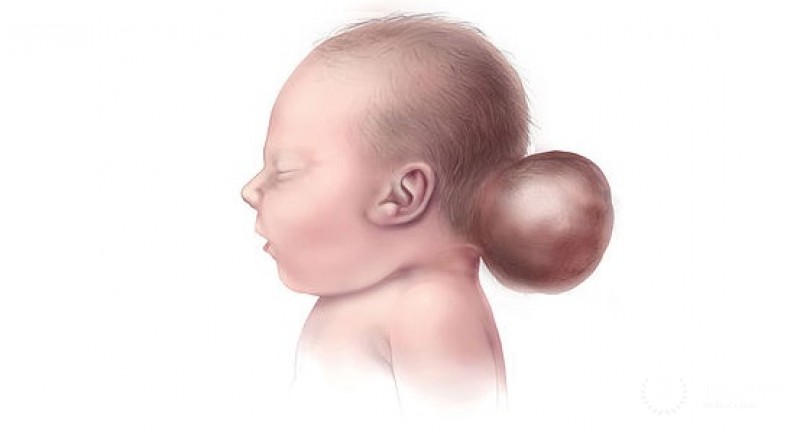 Энцефалоцеле (мозговая грыжа) у детей: вся информация