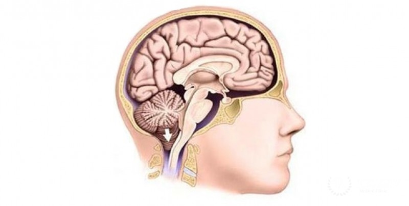 Мальформация Арнольда-Киари: информация