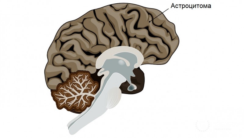 Анапластическая астроцитома у детей: информация