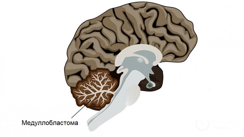 Медуллобластомы у детей: информация