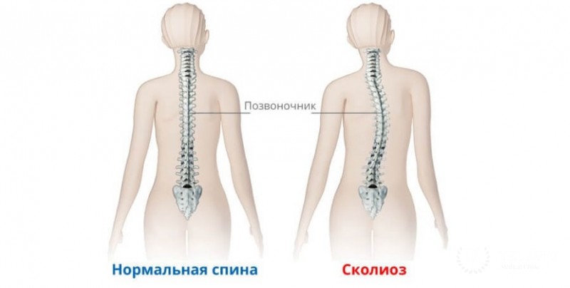 Сколиоз у детей: информация