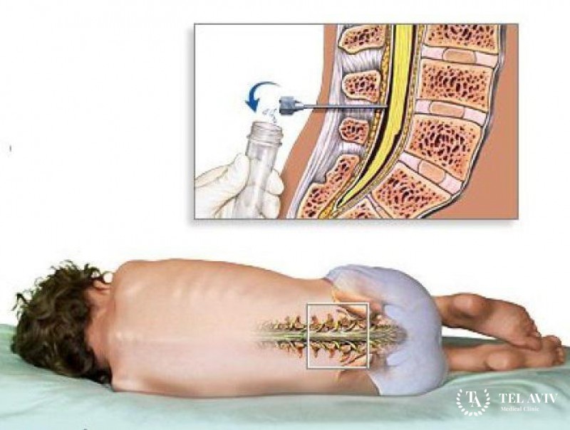 Люмбальная пункция в детской нейрохирургии