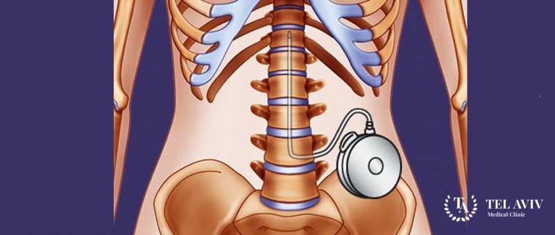 Имплантация интратекальной баклофеновой помпы: информация