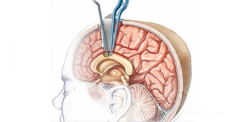 Гемисферэктомия в детской нейрохирургии