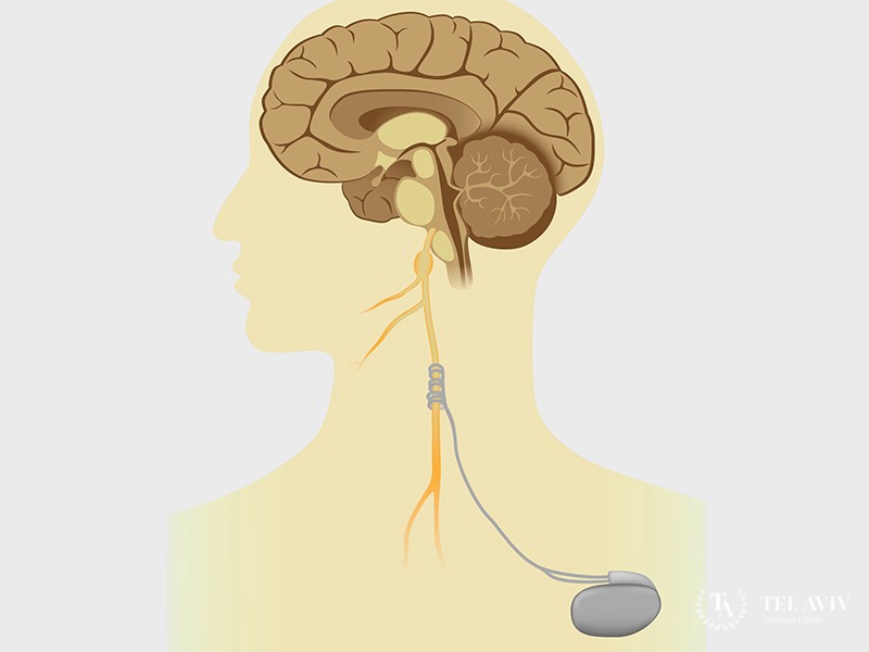 Электростимуляция блуждающего нерва: информация