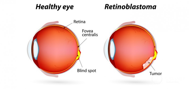 Retinoblastoma in a child: symptoms, diagnosis, varieties of the disease
