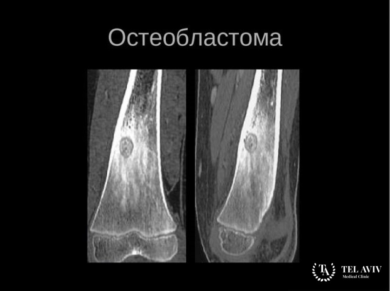 Агрессивная остеобластома: общая информация