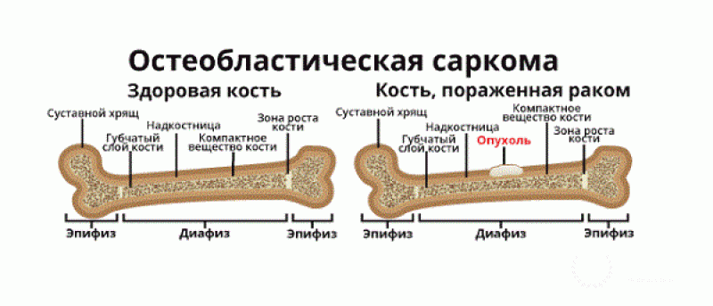 Гигантоклеточная опухоль костей (остеокластома): информация