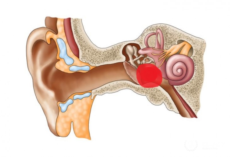 Гломусная опухоль: общая информация