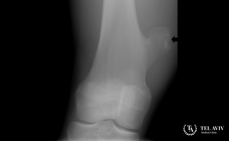 Остеохондрома: общая информация