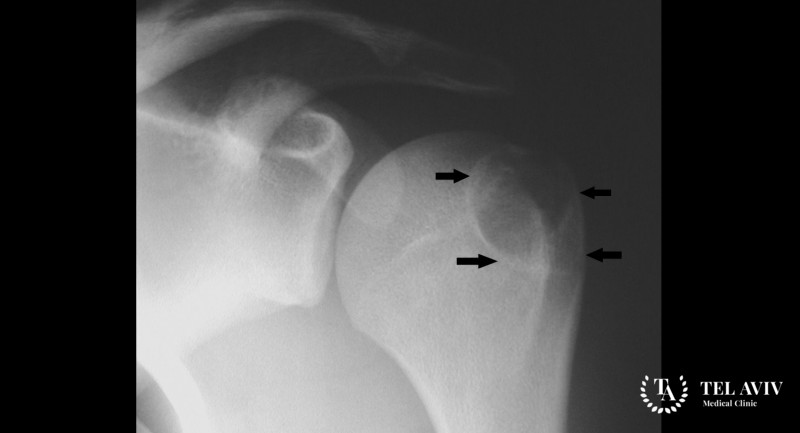 Хондробластома: общая информация