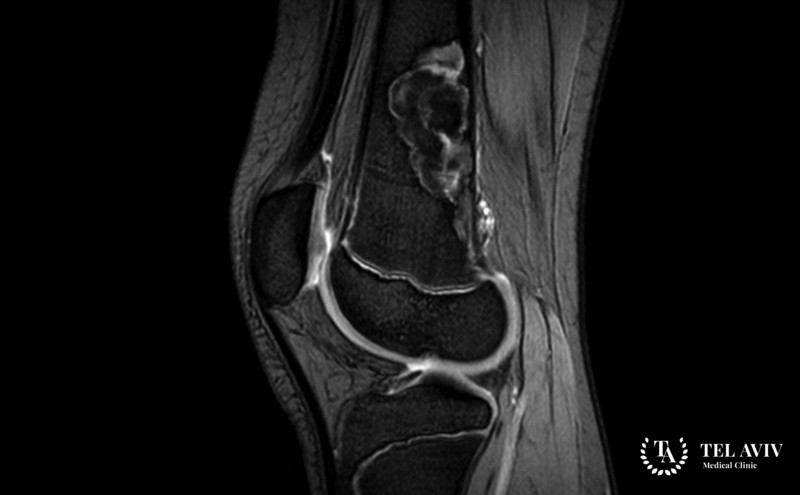 Хондромиксоидная фиброма: общая информация
