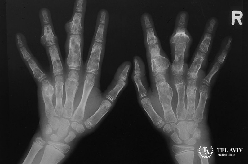 Энхондрома: общая информация