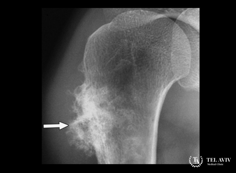 Злокачественная фиброзная гистиоцитома: информация