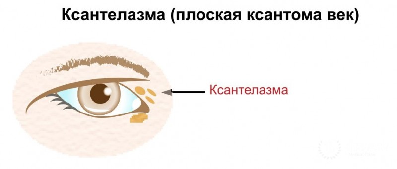 Ксантома: вся информация