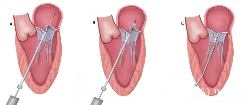 Minimally invasive surgery