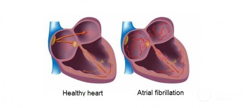 Treatment for atrial fibrillation