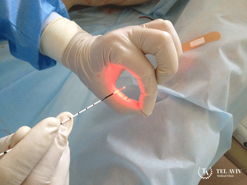 Endocardial radiofrequency (RF) ablation treatment for atrial fibrillation (AF)