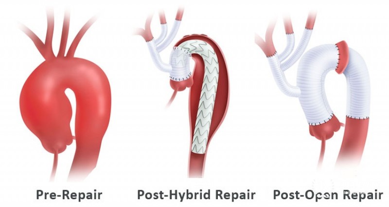 Aortic arch repair surgery