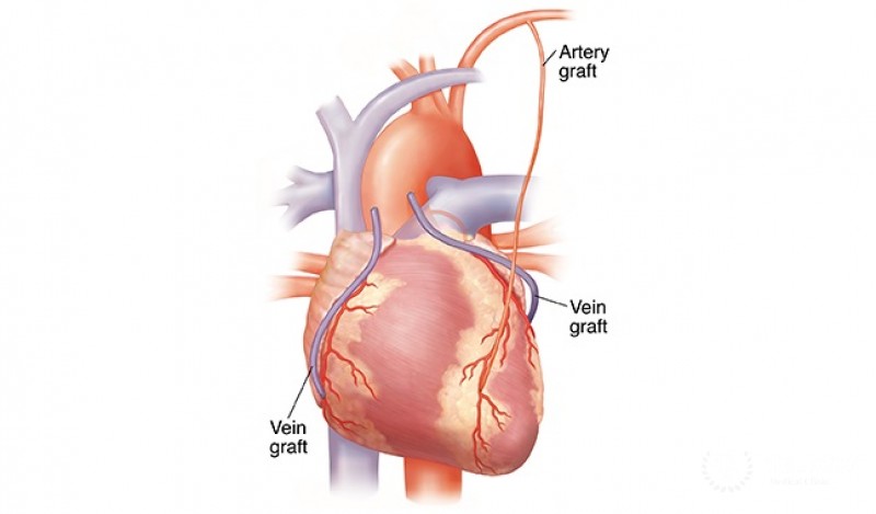 Off-pump coronary artery bypass surgery (OPCAB)