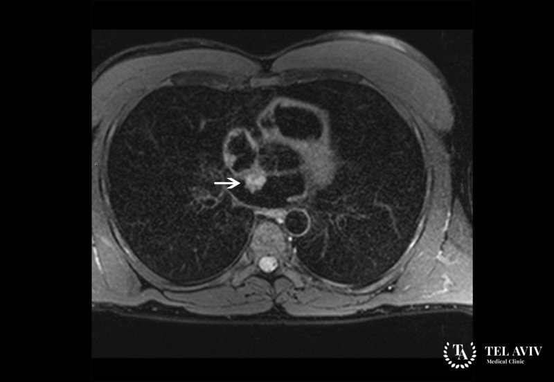 Метастатические опухоли сердца: информация