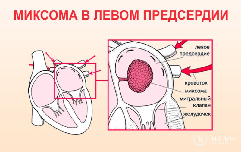 Миксома сердца: общая информация