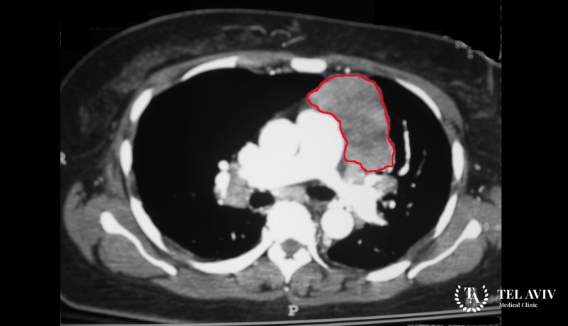 Перикардиальные кисты: общая информация