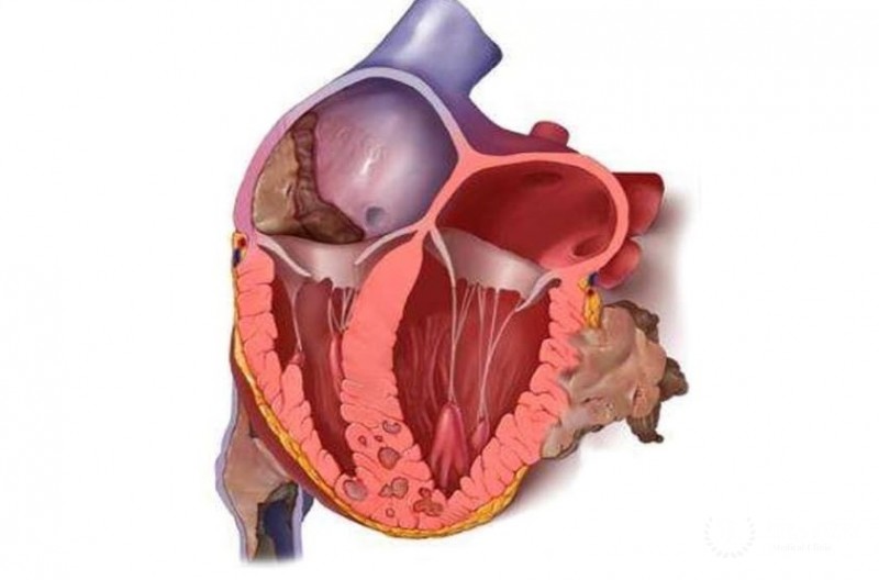 Лейомиосаркома сердца: общая информация