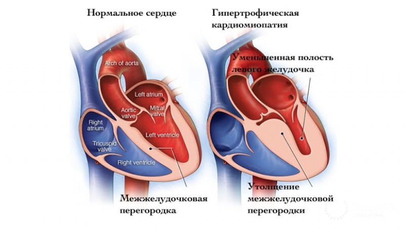 Гипертрофическая обструктивная кардиомиопатия: общая информация