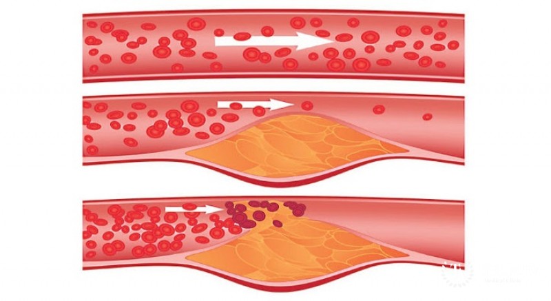 Гиперхолестеринемия: общая информация