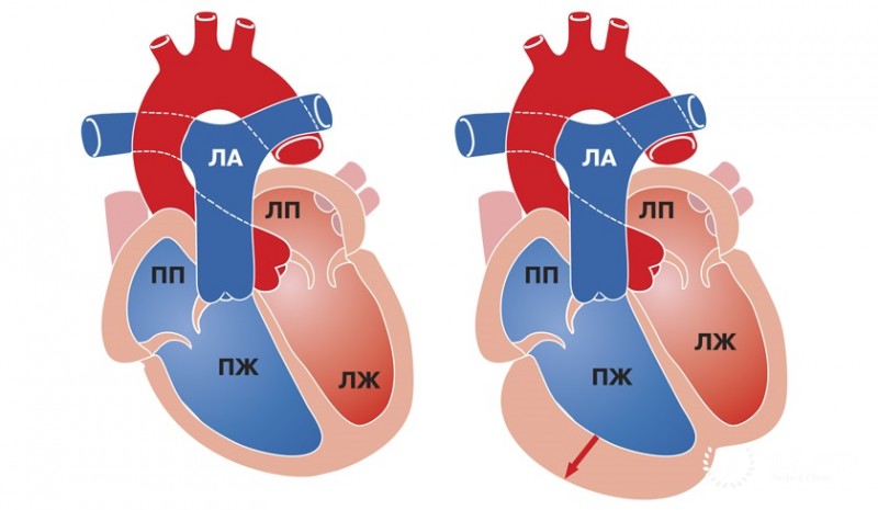 Кардиомиопатия правого желудочка: общая информация