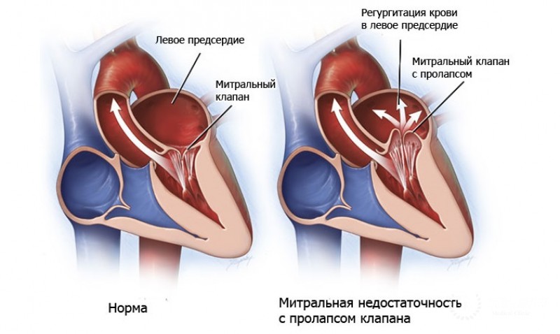 Врождённые пороки митрального клапана сердца: общая информация