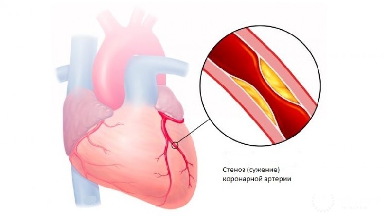 Стенокардия: полная информация
