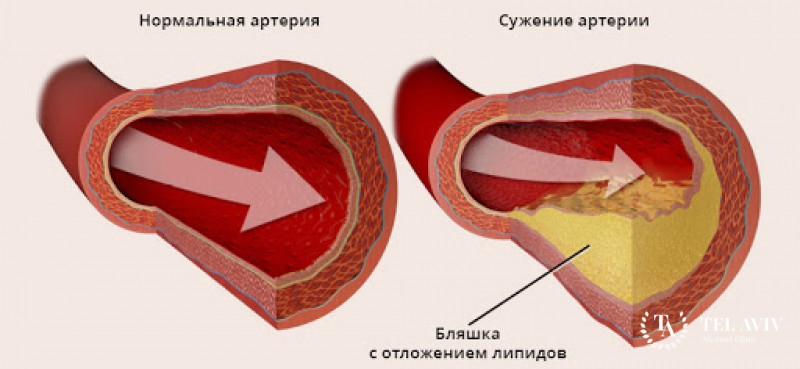 Сахарный диабет и сердце: общая информация