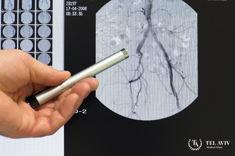 Терапевтическая коронарная ангиография: особенности