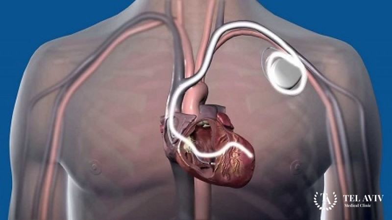 Имплантация дефибрилляторов: полная информация