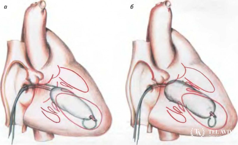 Баллонная вальвулопластика: полная информация