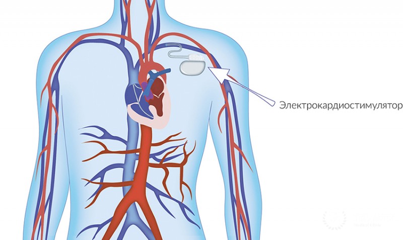 Имплантация электрокардиостимулятора в отделении кардиологии