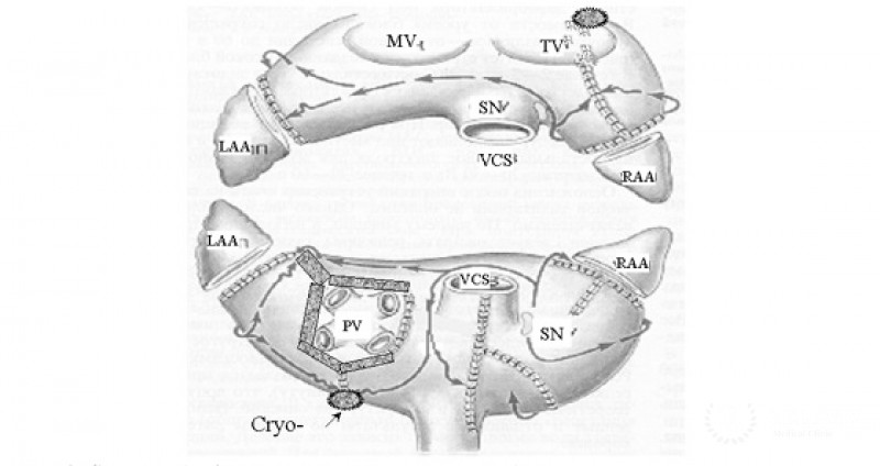 Хирургическая операция «Лабиринт»: полное описание