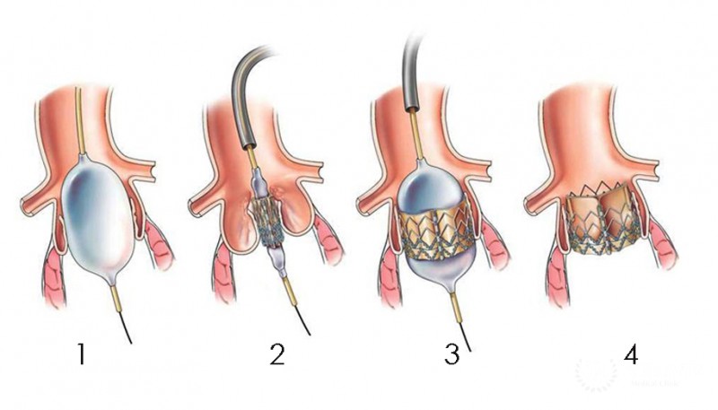Транскатетерная имплантация аортального клапана (ТИАК): полная информация