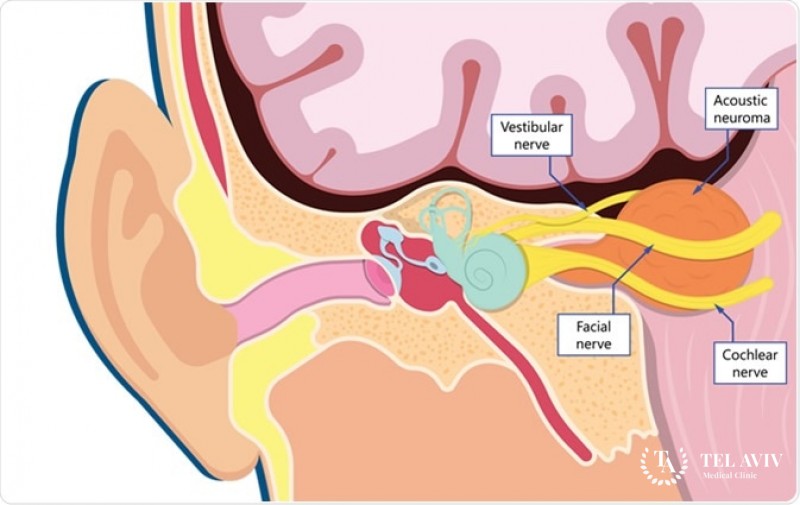 Acoustic neuroma (vestibular schwannoma): symptoms, diagnosis, treatment
